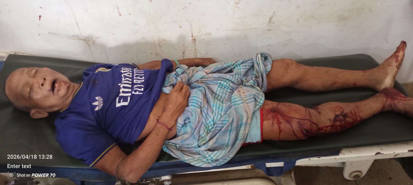 আলীকদমে মোটরসাইকেল নিয়ন্ত্রণ হারিয়ে পাহাড়ে ধাক্কা: নিহত ১, আহত ২